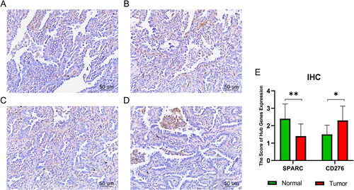 Figure 6. Immunohistochemistry results. (A)SPARC:IHC staining of normal lung tissue. (B) SPARC:IHC staining of tumour lung tissue. (C) CD276:IHC staining of normal lung tissue. (D) CD276:IHC staining of tumour lung tissue. (E) Quantitation of hub gene expression at the level of protein. *p < .05; **p < .01. Scale bars = 50 µm; 400× magnification (CX43, Olympus, Tokyo, Japan).
