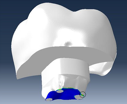 Figure 11 Shows where high-stress concentrations are found on the ECC interfacial surface. The restoration underwent a debonding initiation, as indicated with the dashed black circle, wherein the contact stress ratio reached a value of 1 at the distal region on the base fiber.