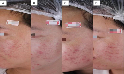 Figure 9 A 30-year-old female showing acne recurrence following IPL 590 nm treatment: (A) Before 590 nm treatment; (B) after the first session of IPL 590 nm; (C) after the second session of 590 nm treatment, and (D) at the follow-up.