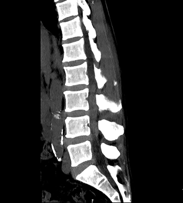 Figure 1 Preoperative CT showed lamellar hematomas in L2-L5 vertebral canal.