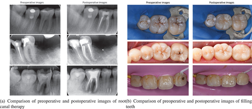 Figure 6. Comparison of preoperative and postoperative images of root canal therapy and filling teeth.