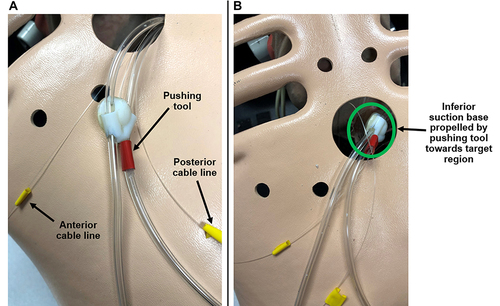 Figure 11 Process of positioning the inferior suction base near the apex of the heart. (A) The anterior and posterior cable lines are pulled in order to direct the pushing tool forwards, thereby propelling the inferior suction base towards its target region. (B) The cable lines continue to be pulled until the inferior suction base reaches the apex of the heart.