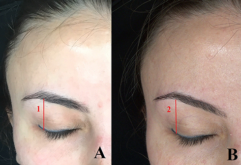 Figure 2 Change in height of upper eyelid at PA1 (A1) and PA4 (B2).