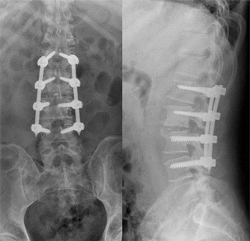 Figure 2 X-ray examination was performed on the third day after operation. The results showed that the internal fixation was firm and the position of the fusion cage was satisfactory.