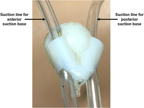 Figure 4 Prototype of the inferior suction base. The two suction lines from each superior suction base are directed through the inferior suction base. For the purposes of this study, suction is not required on the inferior suction base.