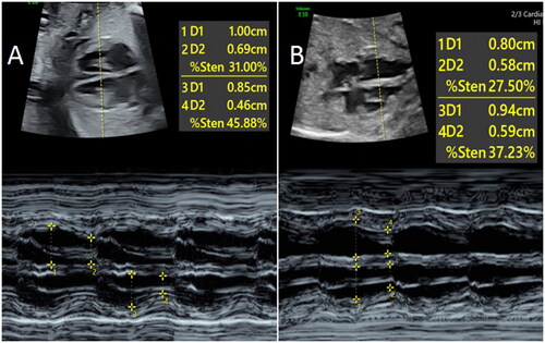 Figure 2. The diastolic and systolic diameters of left and right ventricleswere measured by M-mode echocardiography and FS were calculated. A is a 25-weeks normalfetus and B is a 25-weeks fetus in a pregnant woman with hypothyroidism. The RV FS of Bfetus was lower than that of A fetus. 
