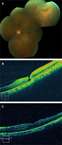 Figure 1 (A) Wide field fundus photograph showing a large horseshoe tear in the superotemporal area after demarcation laser photocoagulation barricade. (B) Time domain optical coherence tomography of the left eye showing a full thickness macular hole with an epiretinal membrane. (C) Time domain optical coherence tomography of the left eye showing regression of the macular anatomy to normal after macular hole repair.