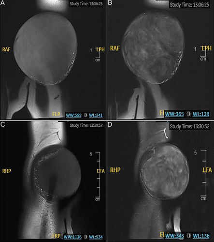 Figure 2 MRI imaging of xanthomas masses on left (A and B) and right (C and D) elbows. The masses revealed low signal intensity on T1-weighted images and low-high mixed signal intensity on T2-weighted images.