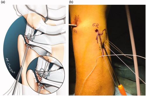 Figure 3. (a) The placement of two transosseous FiberWire sutures through the foveal aspect of the TFCC complex. The wire-loop is pulled out of the joint, through a 6 R arthroscopic portal using a grasper. (b) Then, the wire-loop is fed by the suture to be retracted back throughout the working tunnel.