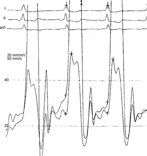 Figure 2 Dip-and-plateau phenomenon in the left and right ventricles of a patient with persisting signs of tamponade after pericardiocentesis. The persistance of an elevated end-diastolic pressure with the classic square-root sign of tamponade is diagnostic, although tamponade is no longer present. This is one of the characteristic hemodynamic features of ECP.