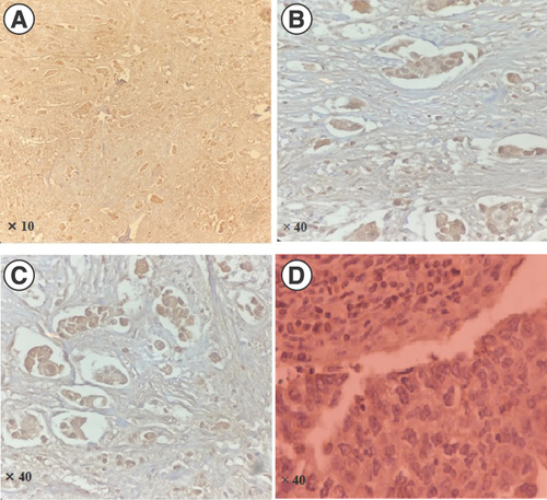 Figure 1. Positive (A–C) and a negative (D) immunoreactivity of prolactin receptor in paraffin embedded tissues from triple negative breast cancer.