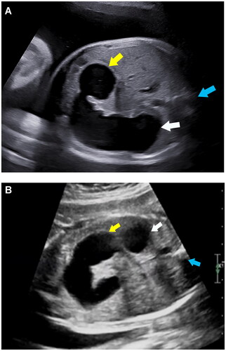Figure 3. (a) A fetus was diagnosed annular pancreas by postnatal surgery. Prenatal ultrasound shown that the dilated bowel connected with the stomach, and the end of the enlarged intestine was located at the level of right side of spine at 35 weeks. White arrow indicates the stomach; yellow arrow indicates the end of the enlarged intestine; blue arrow indicates the spine. (b) A fetus was diagnosed high jejunal atresia by postnatal surgery. Prenatal ultrasound shown that the enlarged intestine, in a “C” shape, connected with the stomach, and extended from the right side of the abdominal cavity to the left side, and the end of the enlarged intestine significantly exceeded the level of left side of spine at 29 weeks. White Arrow indicates the stomach; yellow arrow indicates the end of the enlarged intestine; blue arrow indicates the spine.
