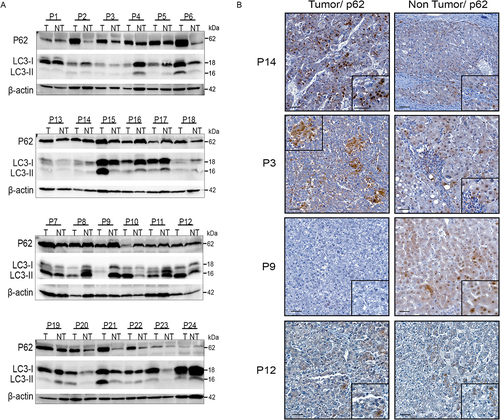 Figure 1. Diversity and variability of autophagic flux in human HCC. (A) Western blotting of anti-p62 and anti-LC3 on extracts of tumor (T) and non-tumor (NT) liver tissue from 24 HCC patients. P2: patient number 2. (B) Representative immunohistochemical staining of p62 in tumor and non-tumor areas from the indicated patients (scale bars, 50µM).