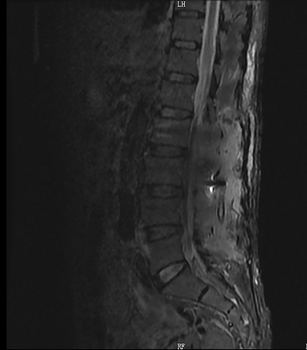 Figure 3 Postoperative MRI indicated that the L2-L5 intraspinal hematoma had been completely cleared.