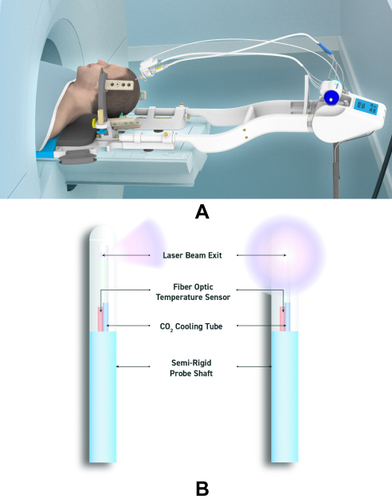 Figure 18 NeuroBlate commercial laser-based thermal ablation system for neurosurgical applications. (A) Robotic positioning system, enabling probe positioning from workstation during the procedure. (B) Two optic laser probes available for NeuroBlate: directional and diffusing tip probes.8,90,91 Reproduced with permission from Monteris Medical. NeuroBlate® system. [Online] Available from: https://www.monteris.com/neuroblate-system/.90