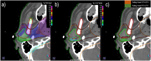 Figure 3. Axial view corresponding to (a) EQD2 of the planned physical doses, (b) surviving cell number distribution after 35 fractions, and (c) marked voxels with failing control. In solid lines, the volumes of interest: patient body contour, PTV and CTV are green, dark brown, and brown, respectively; mandible, neck, parotids, and spinal cord are red, orange, light green, and light pink.