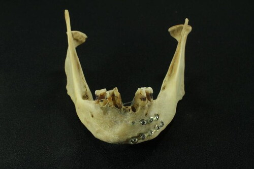 Figure 4. Jaw showing metallic osteosynthesis composed of two Erich bars and poorly maintained teeth.