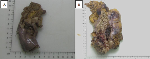 Figure 2 (A) Gross pathology of a tumour of the terminal ileum. (B) Gross pathology of a tumour of the descending colon.