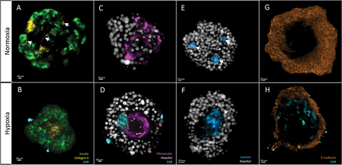 Figure 7. Morphological analysis of target proteins in human islets, after 5 days of either normoxia (top row) or hypoxia (bottom row). 2D cross sections in the middle of the islets. The same display parameters are identical for each protein. (a) Collagen 4 can be found in structures resembling blood vessels in group ND5 (arrows). (b) Central scar showing condensed Collagen 4 stain; note hypoxic cells (CA9-positive) around this area. (c) Fibronectin is found throughout the islet in normoxic conditions. (d) In hypoxia, it accumulates in the center of the islet, in the fashion of scarring tissue. This last picture is also a clear example of what we name architectural loss: ECM condensation, and scarce nuclei, which also present altered morphology, like irregular shape and small size. Note the presence of hypoxic cells (CA9) around the fibrotic core. (e) Laminin forms small, scattered nodes in normoxic conditions. (f) In hypoxia, it is found in central scars. (g) E-cadherin, a membrane marker, is found in the outer layers of islets while avoiding central areas. H) these holes in the signal are more evident in hypoxic conditions, where the central area can be populated by hypoxic cells (CA9-positive).