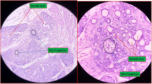 Figure 4 Histologic sections revealed acini, ducts (red arrow) and Islet cells (blue arrow) specific to the pancreas and confirming the diagnosis of pancreatic rest.