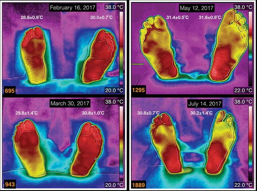 Figure 1. Four thermograms taken in four different dates. At the top of each thermogram is the date of acquisition, and the average temperature is written above each foot. The thermograms numbered 695 and 943 correspond to a female, 59 years old, BMI of 28 kg/m2, 14 years with diagnosis of diabetes mellitus. The thermograms numbered 1295 and 1889 are from a male patient, 73 years old, BMI of 23.6 kg/m2, 23 years with diagnosis of diabetes mellitus.