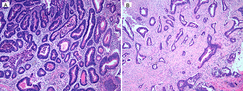 Figure 3 (A) The picture shows ileal adenocarcinoma cells found in sections of the resected tissue. (B) The picture shows the descending colon intestinal adenocarcinoma cells found in the resected tissue sections.