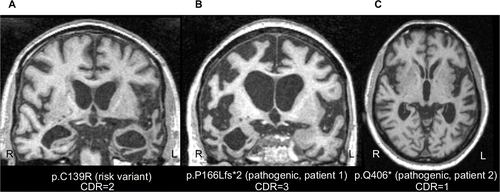 Figure 2 Neuroimaging from select GRN variant cases.