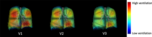 Figure 3 Graphical illustration of ventilation maps at various timepoints from a representative patient. A decrease in ventilation heterogeneity is apparent visually by more regions nearing average ventilation (green and yellow), rather than interspersed regions of high (red) and low (blue) ventilation. Note the improvement in ventilation heterogeneity of the left lung between V2 and V1, and of the right lung between V3 and V2. V1, baseline; V2, 4-week post treatment of left lung; V3, 12-month post treatment of right lung.