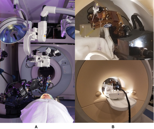 Figure 9 MRI-compatible neurosurgical robotics. (A) NeuroArm MRI-compatible neurosurgery robot, shown with patient in foreground and MRI scanner in the background. Reproduced with permission from NeuroArm. Project.34 (B) Development of MRI-compatible deep brain stimulation robotic assistant by G.S. Fischer et al35 Unpublished DBS robot images graciously contributed by G.S. Fischer of Worcester Polytechnic Institute.