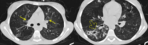 Figure 1 Axial NCECT at the level of the right upper lobe bronchus (left) and at the right lower lobe bronchus (right), showing bilateral peri-hilar thick-walled cylindrical bronchiectasis (arrows) and bronchiectatic changes with cylindrical and varicoid components, some with mucus plugs, as well as cavitating and non-cavitating fibrotic changes within the apical segment of the right lower lobe (open arrow).