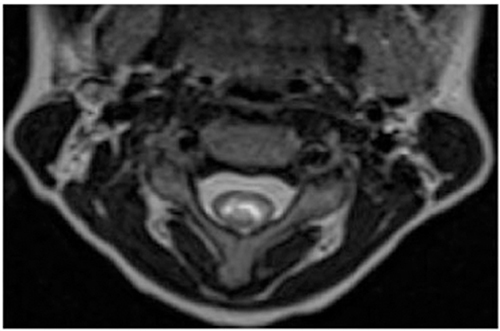 Figure 2 Cervical axial spinal MRI shows T2 hyper intense lesion at C2 level.