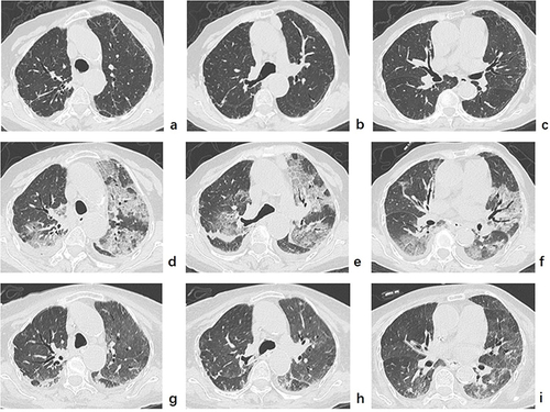 Figure 4 Sequential chest computed tomographic images of an 87-year-old woman infected with the Omicron variant. (a–c) Initial computed tomography images show a few peripheral ground-glass opacities (GGOs) and linear shadows in both lungs on the 2nd day after diagnosis. (d–f) Twelve days later when the reverse-transcription polymerase chain reaction results became negative, the follow-up computed tomography images revealed imaging progress with bilateral multi-patchy GGO displaying crazy-paving patterns, intralobular lines, vascular enlargement patterns, and pleural effusion. (g–i) After another seven days, follow-up computed tomography images demonstrated an obvious absorption of lung abnormalities after corticosteroids and immunoglobulin therapy.