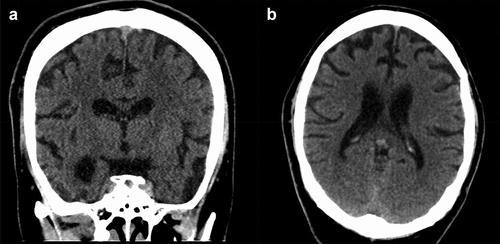Figure 2. a. coronal and b. axial sections of head CT during hospitalization in March 2020, 6 months after the scan shown in Fig. 1 and 9 months after initial symptoms.