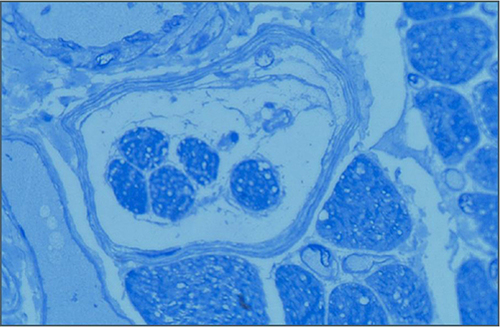 Figure 4 Micrograph showing a transverse section of human extraocular muscles displaying a muscle spindle with 5 intrafusal fibres encapsulated by a capsule of perineural tissue. Stained with Toluidine blue.