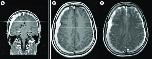 Figure 1. Bilateral subdural hematoma and diffuse pachymeningeal enhancement.T1-weighted MRI images with gadolinium enhancement displayed the presence of bilateral subdural hematoma and widespread pachymeningeal enhancement, as observed in both coronal (A) and axial (B) sections. Additionally, axial sections of Flair MRI exhibited bilateral subdural hematoma (C).