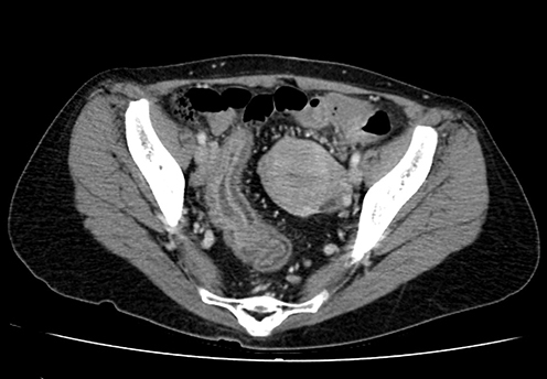 Figure 1 Abdominal CT showed continuous edematous wall thickening from the sigmoid colon to the rectum.