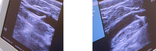 Figure 4 Ultrasound images showing tip of MOCA catheter.