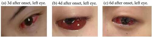 Figure 1. Images of left eye of a 28-year-old female who developed an acute ocular symptoms 3 days after COVID-19 vaccination.
