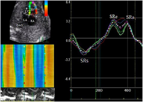 Figure 3. The right ventricular global longitudinal strain rate curve. SRs: systolic wave; SRe: early diastolic wave; SRa: late diastolic wave; LV: left ventricle; LA: left atria; RV: right ventricle; RA: right atria; DAO: descending aorta.