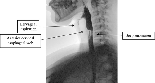 Figure 1 Barium swallow study, lateral view showing laryngeal aspiration, an anterior cervical esophageal web, and jet phenomena.