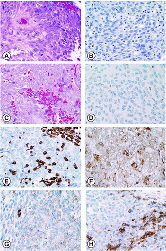 Figure 2. The patient's atypical teratoid rhabdoid tumor (AT/RT) on histology.H&E sections demonstrate a malignant neoplasm characterized by cells with vesicular chromatin and visible nucleoli in both the initial resection and the re-resection (A, C). Immunohistochemistry for BAF47 (INI1) shows loss of expression in tumor cells in both the initial resection (B) and the re-resection (D). Immunohistochemistry performed on the re-resection was positive for vimentin (E), smooth muscle actin (F), and EMA (G). PDL-1 (22C3) performed on the re-resection was positive in approximately 30% of neoplastic cells (H).