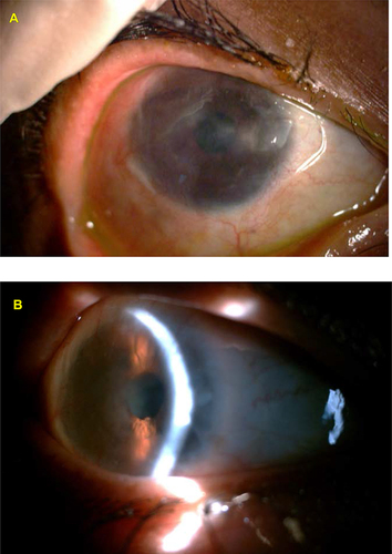 Figure 14 (A) The patient with epidermolysis bullosa 3 weeks post AMT. (B) The same eye 4 years later with improved vision and stable ocular surface.