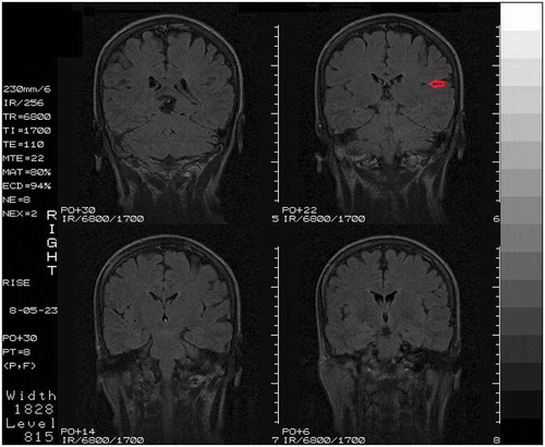 Fig. 2. Coronal section of follow-up MRI, showing an ischemic stroke restricted to the left claustrum (red arrow).