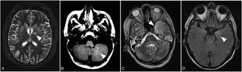 Figure 4. Representative asymmetric lesions. Axial T2 weighted image with left hemispheric changes of the globus pallidus (arrow) in patient B on day 39 (A). Axial FLAIR image with unilateral signal increase of cerebellar white matter (arrow) in patient D1 on day 107 (B). Axial T2 weighted image showing left hemispheric signal increase of the temporal lobe (arrow) in patient D2 on day 78 (C). Axial FLAIR image demonstrating unilateral signal increase of the left amygdala (arrow) in patient F on day 10 (D).