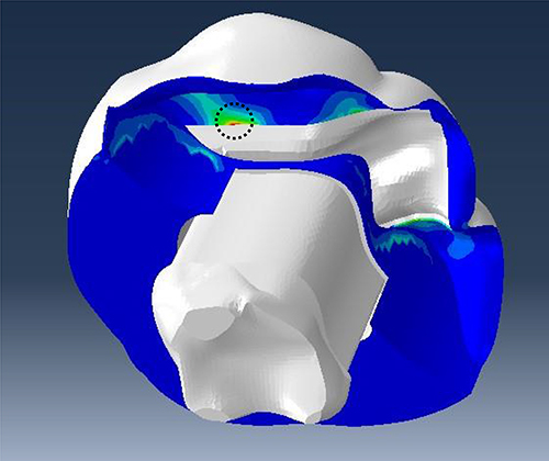 Figure 10 Shows where high-stress concentrations are found on the PCC interfacial surface. The restoration underwent a debonding initiation, as indicated with the dashed black circle, wherein the contact stress ratio reached a value of 1 at the fiber occlusal between the enamel and the restoration.