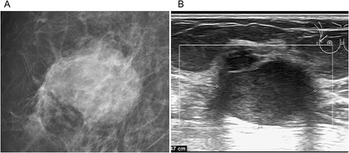 Figure 2 Image of a 72-year-old female patient. (A) The X-ray shows a high-density oval mass in the upper outer quadrant of the right breast with infiltrative margins and no burr sign. (B) The ultrasound shows a hypoechoic mass with uneven internal echoes and slightly reduced posterior echoes. The pathologic diagnosis was a non-specific invasive ductal carcinoma of the right breast (grade II), 2.8 cm×2.5 cm×2 cm in size.