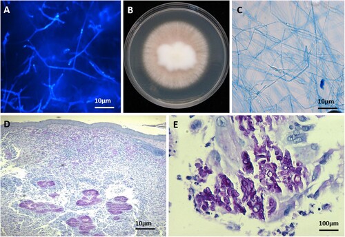 Figure 2. A. Direct microscopy of lesions revealed septate, branched hyphae (Calcofluor-white staining); B. macroscopy of the isolate with poor conidiation (PDA, 14 d, 28°C); C. microscopy of the cultured strain showing irregular hyphae morphologically (lactophenol cotton blue staining); D, E. skin biopsy specimens showing intense inflammatory infiltrates, aggregates of hyaline hyphae in the dermis with infectious granulomata (PAS staining; original magnification × 40 and × 400).