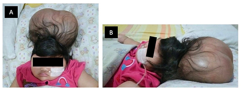 Figure 1 Clinical presentation of the lesion, (A) from front (B) from the side.