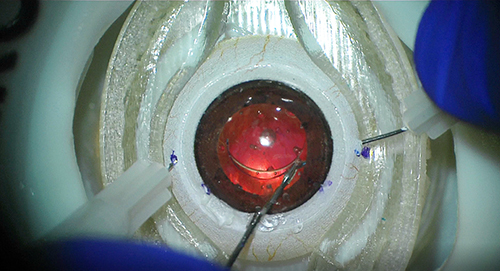 Figure 2 The Bioniko Okulo BR8 for secondary intraocular lens fixation via the Yamane technique.