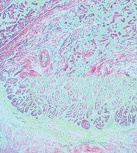 Figure 1. Endometrium infiltrated by partially necrotic tumour, characterised by irregular complex glands lined by stratified columnar epithelium with abundant eosinophilic cytoplasm and hyperchromatic nuclei, endometrioid endometrial carcinoma grade 1, pt1a, FIGO 1a.